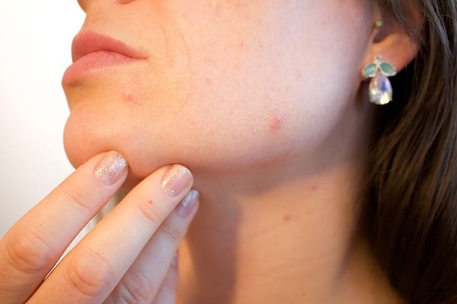 How to Make Your Own Acne Treatment